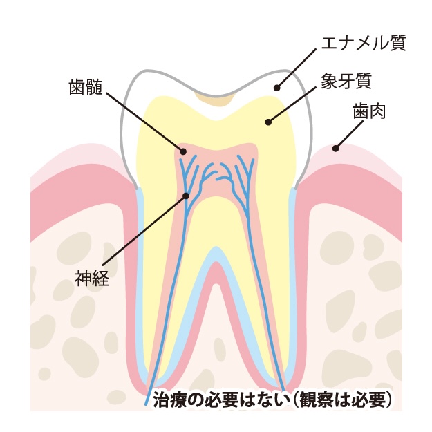 初期むし歯