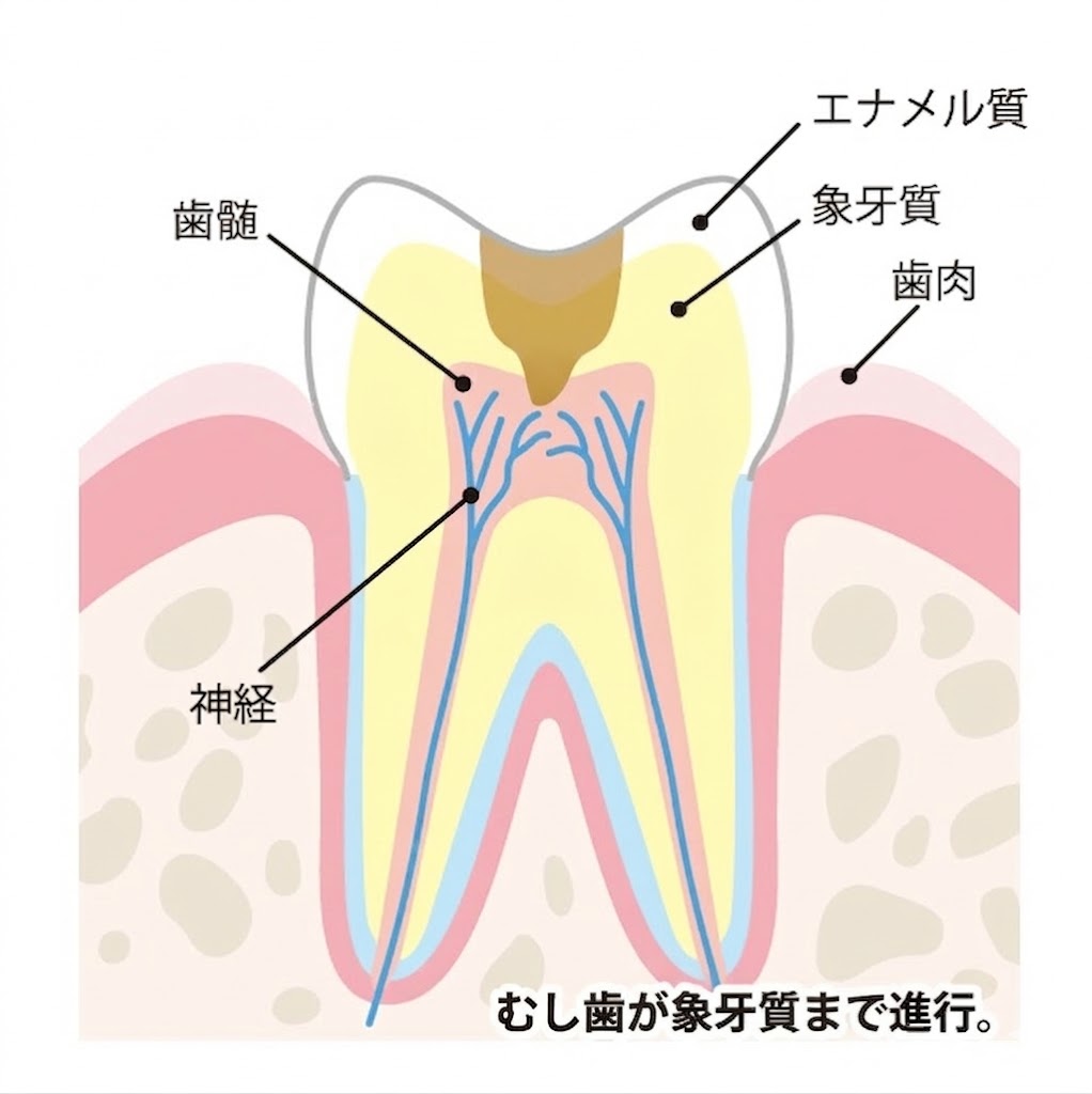 象牙質のむし歯