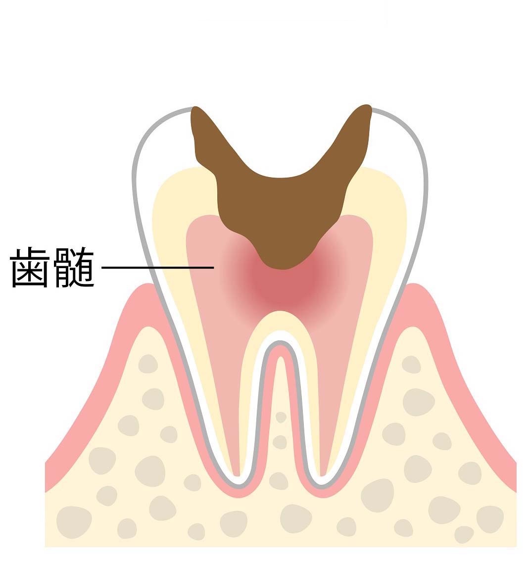 神経まで達したむし歯