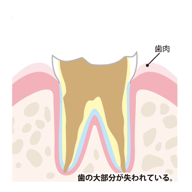 末期のむし歯